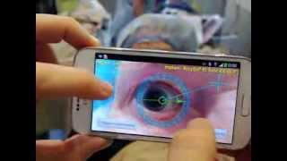 TOREASY  first noncontact Smartphone enabled eye marking for toric IOLs [upl. by Elvyn214]