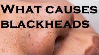 What causes blackheads [upl. by Sisely627]