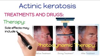 How To Treat and Remove Actinic Keratosis  Actinic Keratosis Treatment And Removal Procedures [upl. by Bush]