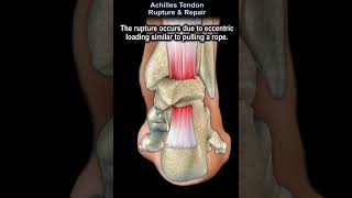 Achilles Tendon Rupture amp Repairshorts [upl. by Eilsehc]