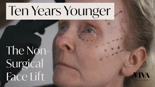 NonSurgical Facelift with Dermal Fillers ❇️ Look 10 Years Younger without Surgery [upl. by Namyaw]