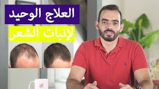 مينوكسيديل  Minoxidil [upl. by Shelley]