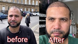 REMOVE SCABS DAY 2 Weeks After HairTransplant [upl. by Leterg]