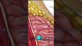 PreOp® Needle Breast Biopsy A StepbyStep Guide 🌸 preop shorts health 👩‍⚕️ [upl. by Earazed]