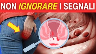 Le EMORROIDI sono IL PRIMO SEGNALE [upl. by Asaeret]