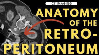 Retroperitoneal anatomy organs and spaces  Radiology anatomy part 1 prep  CT abdomen [upl. by Neehar518]