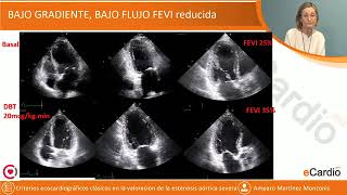 Estenosis aórtica severa ecocardiograma en toma de desiciones [upl. by Sill]