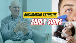 Rheumatoid Arthritis Symptoms You Should NOT Ignore [upl. by Odicalp]