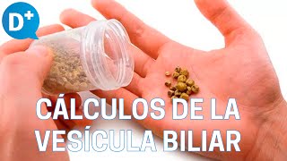 Causas y síntomas de los cálculos de la vesícula biliar [upl. by Radie674]