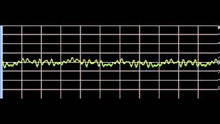 Varicose Veins  Rife Frequencies [upl. by Ecadnac]