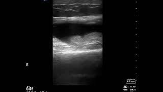 Knee Ultrasound Joint Effusion Suprapatellar Bursa long axis [upl. by Ennairrac910]