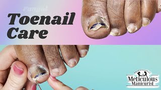 👣Lets Revisit  Toenail Fungus Care at Home👣 [upl. by Lenahs631]