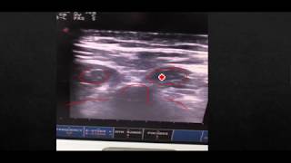 Paraspinal needle Electromyography testing procedure [upl. by Montagna]