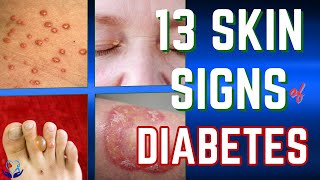 Discover 13 Skin Signs of Diabetes Now [upl. by Ashlan]