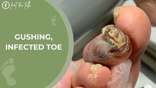 Gushing Infected Toe [upl. by Giles]