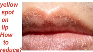 yellow spot on lip what to doFordyces granules in buccal mucosa or lip is it seriously required tt [upl. by Caitlin]