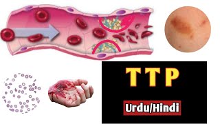 Thrombotic thrombocytopenic purpuraHemolytic uremic syndrome In urduHindiDoctors goalanimation [upl. by Inafetse41]