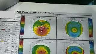 Normal Spherical RGP fitting choose steeper to flatter side [upl. by Ignace]