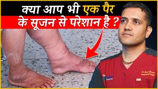 One Leg Swelling or Single Leg Swelling Causes and Treatment  Dr Gaurav Gangwani IR [upl. by Yemerej]