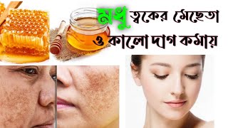 মধু ত্বকের মেছতা ও কালো দাগ কমায় ।। how to treat melasma।। [upl. by Nylaroc876]