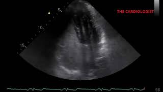 Agitated Saline Study Showing PFOASD with right to left shunt [upl. by Alikat826]