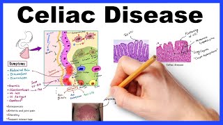 Celiac disease  Pathophysiology Symptoms Histology Diagnosis amp Management [upl. by Devol305]