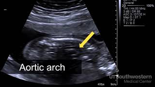 Understanding your fetal ultrasound [upl. by Freyah]