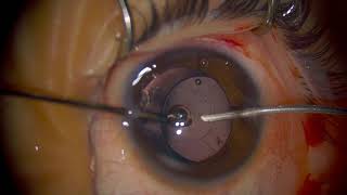 Surgery Lens Aspiration in a Nuclear Lamellar Cataract Dr Jonathan Song [upl. by Airdni]