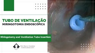 Timpanotomia para Tubo de Ventilação por Vídeo Miringotomy and Ventilation Tube Insertion  EES [upl. by Severin758]