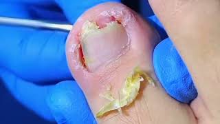 Trimming Removing Dead Skin and Huge Ingrown Toenails [upl. by Attevroc]