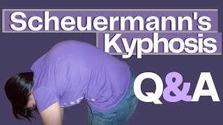 Common Questions About Scheuermanns Kyphosis [upl. by Valerian]