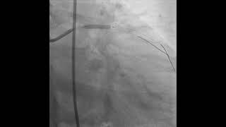 PROVISIONAL STENTING OF LAD  D1 BIFURCATION [upl. by Cesaro]