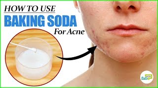 How to Use Baking Soda for Acne  4 Remedies That Really Work [upl. by Davidde]