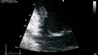 RUPTURE CHORDAE POSTEROMEDIAL PAPILARY MUSCLE  MR PROLAPSE [upl. by Atnuhs]