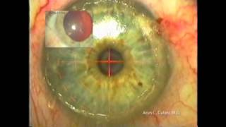 Correcting corneal scars to 2020 vision Laser Vision Surgery and Corneal scars  Gulani Vision [upl. by Fredia35]