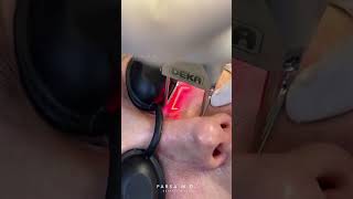 Watch the Under Eye Skin Tightening with Co2 Laser  Dr Kami Parsa [upl. by Eiclek]