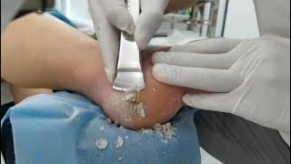 Remove Heel Fissure slowly amp carefully Cracked heel treatment amp Callus removal Dead skin removal [upl. by Tung275]