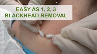 Easy as 1 2 3 Blackhead Removal  Dr Derm [upl. by Greiner]