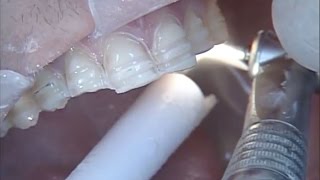 Pre Preparation Contouring To Achieve Ideal Archform With IPS Empress® Veneers [upl. by Ricardo]