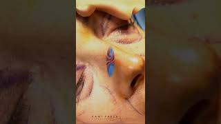 How Its Done Upper and Lower Eyelid Surgery with Dr Kami Parsa [upl. by Missi]