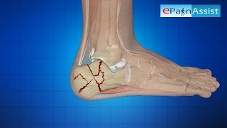 Surgical Treatment for Calcaneus Fracture or Broken Heel Its Types [upl. by Libys]