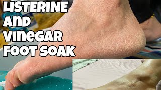 LISTERINE AND VINEGAR FOOT SOAK [upl. by Procter]