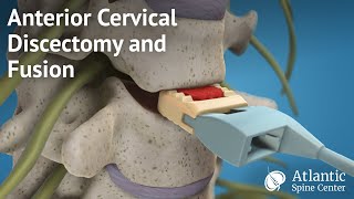 Anterior Cervical Discectomy and Fusion [upl. by Edith]