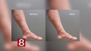 Removing Varicose Veins [upl. by Orlosky]