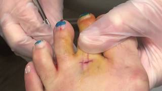 Extensor Hammertoe Surgery [upl. by Yblocaj]