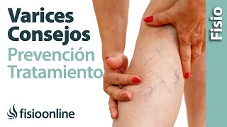 Mala circulación y varices  10 consejos para su prevención y tratamiento [upl. by Fulmer]