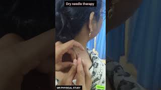 Dry Needles therapy doctor physio shoulderinjury orthodox aiims trending treatment pain [upl. by Ivie551]