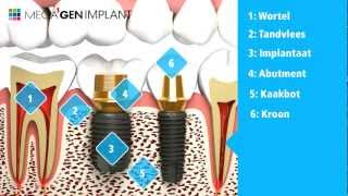 MegaGen Implant  Patient informatie [upl. by Dey961]