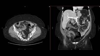 Abdominal Imaging Call Prep Cases Perforated Appendicitis CT Search Pattern [upl. by Edge]