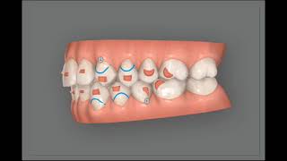 Invisalign clincheck Treatment simulation to corect an open bite for adult patient [upl. by Katie]